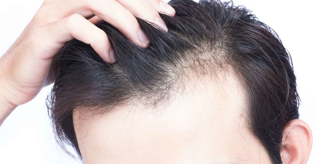 Vitamin D Deficiency Hair Loss Effects Of Vitamin D On Hair